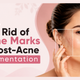 How to Get Rid of Acne Marks and Post-Acne Pigmentation